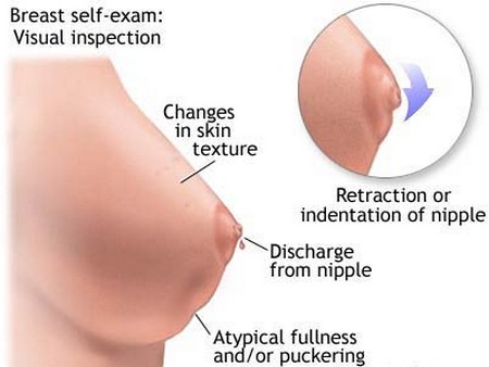 Breast Lumps Types 21