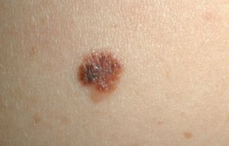 Telangiectatic nevus - definition of telangiectatic nevus ...