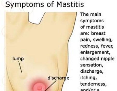 Breast Lumps Types 70