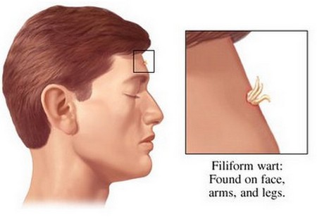 common warts on face. Facial warts are generally