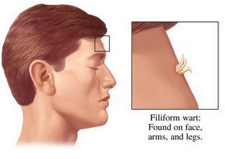 Warts | American Academy of Dermatology