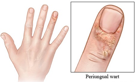 common wart images. common warts on fingers.