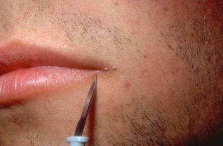 common warts on face. Common Warts