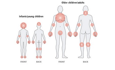 Atopic eczema, atopic dermatitis. - DermNet New Zealand