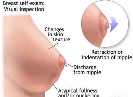 siRNA-toting nanoparticles inhibit breast cancer metastasis 