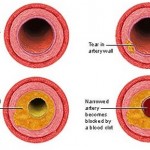 Types of Heart Disease