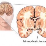 Types of Cancer