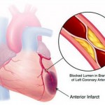 Types of Heart Disease Disorder