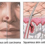 Types of Skin Cancer