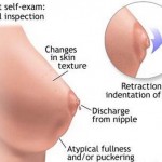 Types of Breasts Lumps
