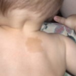 Types of Birthmarks