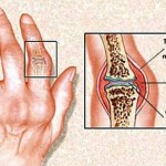 Types of Arthritis
