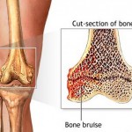 Types of Fractures