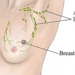 Types of Breast Cancer