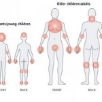 Types of Eczema